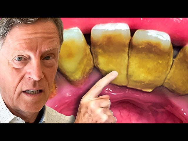 #1 Best Way to Remove Plaque (Tartar) AT HOME