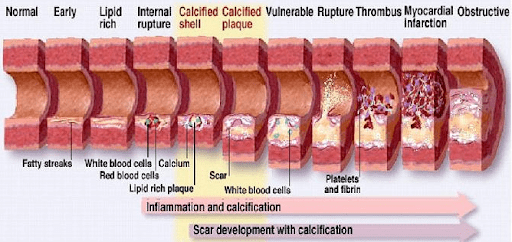 How to Reverse 20 Years of Arterial Plaque | Prevmedhealth