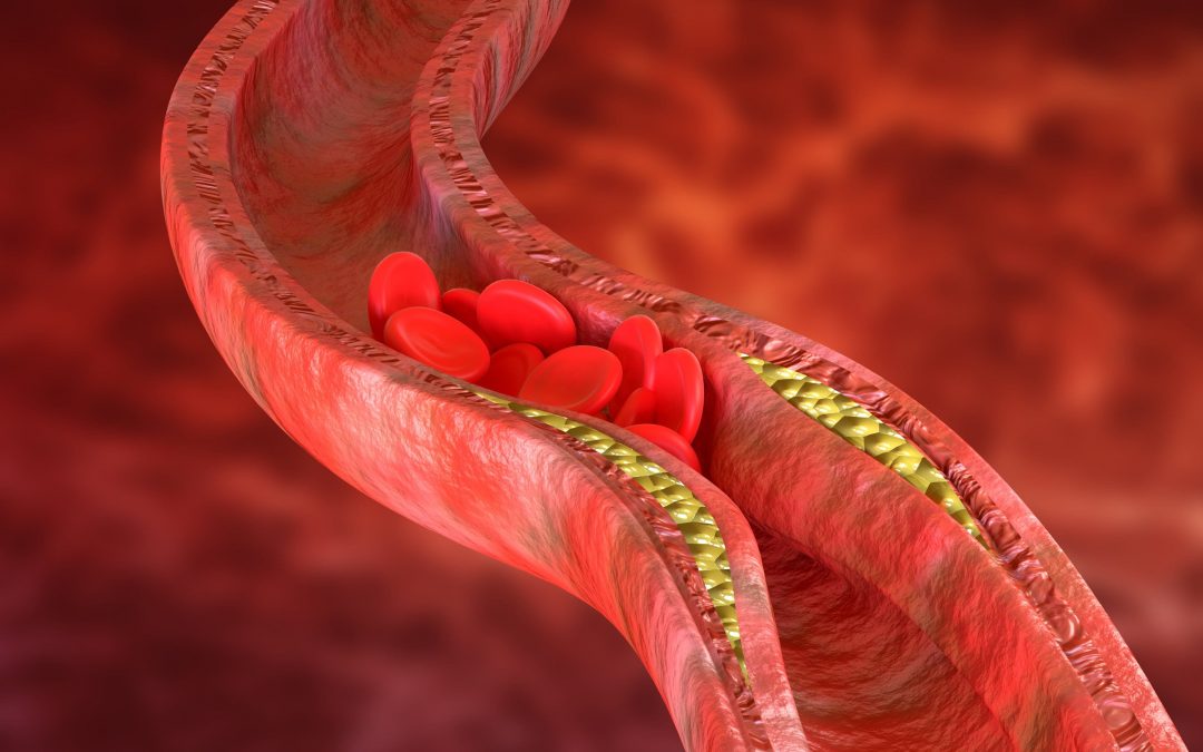 Arterial plaque
