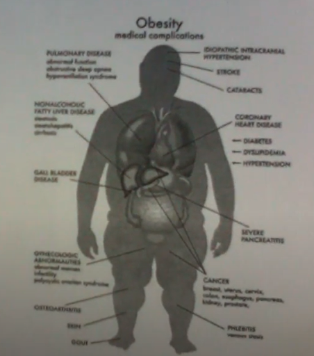 Obesity Medical Complications