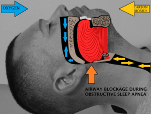 Airway obstruction during sleep.