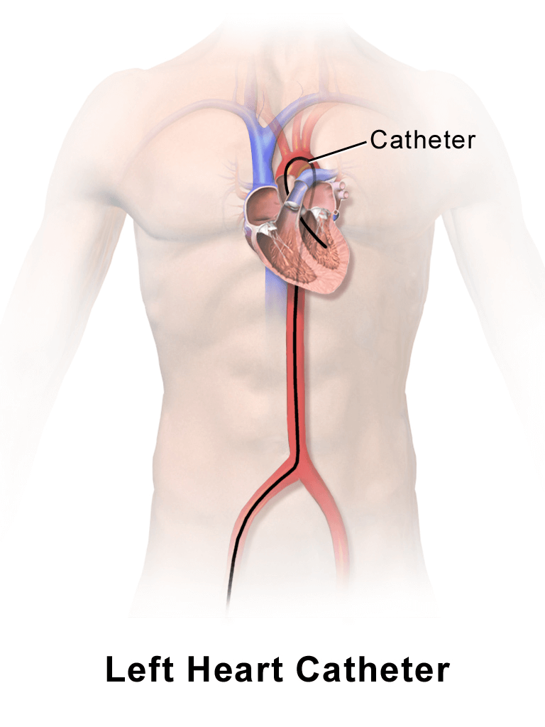 Cardiac cath