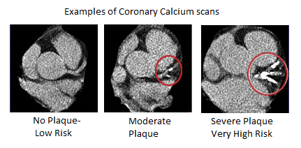 Examples of Coronary Calcium Scans