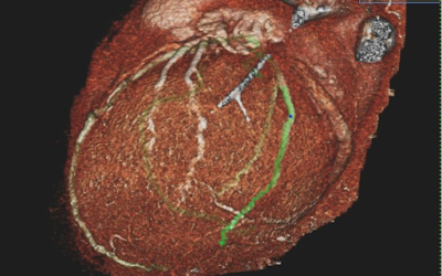 CT Angiography: The Plaque Screening Test with Lots of Potential