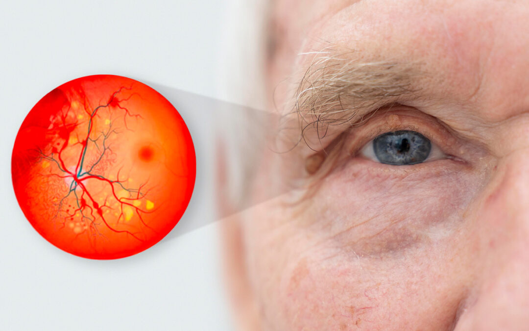 Diabetic Retinopathy – not just diabetes and links to the brain