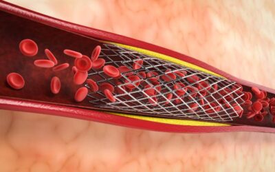 Thinking About Getting a Stent? or a Bypass? Read this First