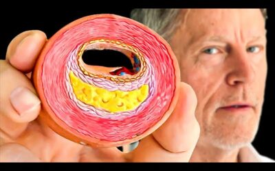 #1 Way to Find Clogged Arteries