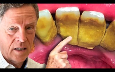 #1 Best Way to Remove Plaque (Tartar) AT HOME